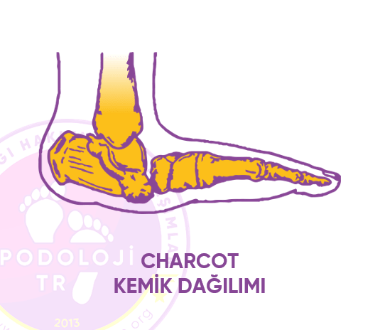 Charcot Deformitesi ve Tedavisi