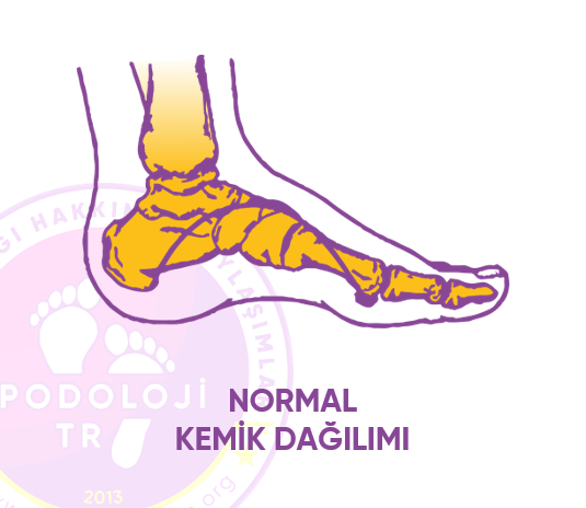 Charcot Deformitesi ve Tedavisi