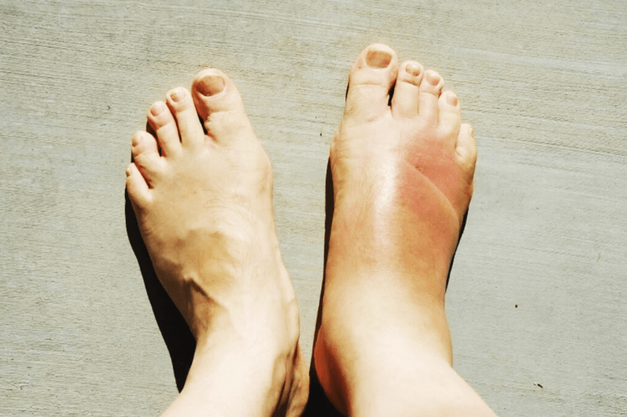 Gut Hastalığı'nda Ayak Sorunları