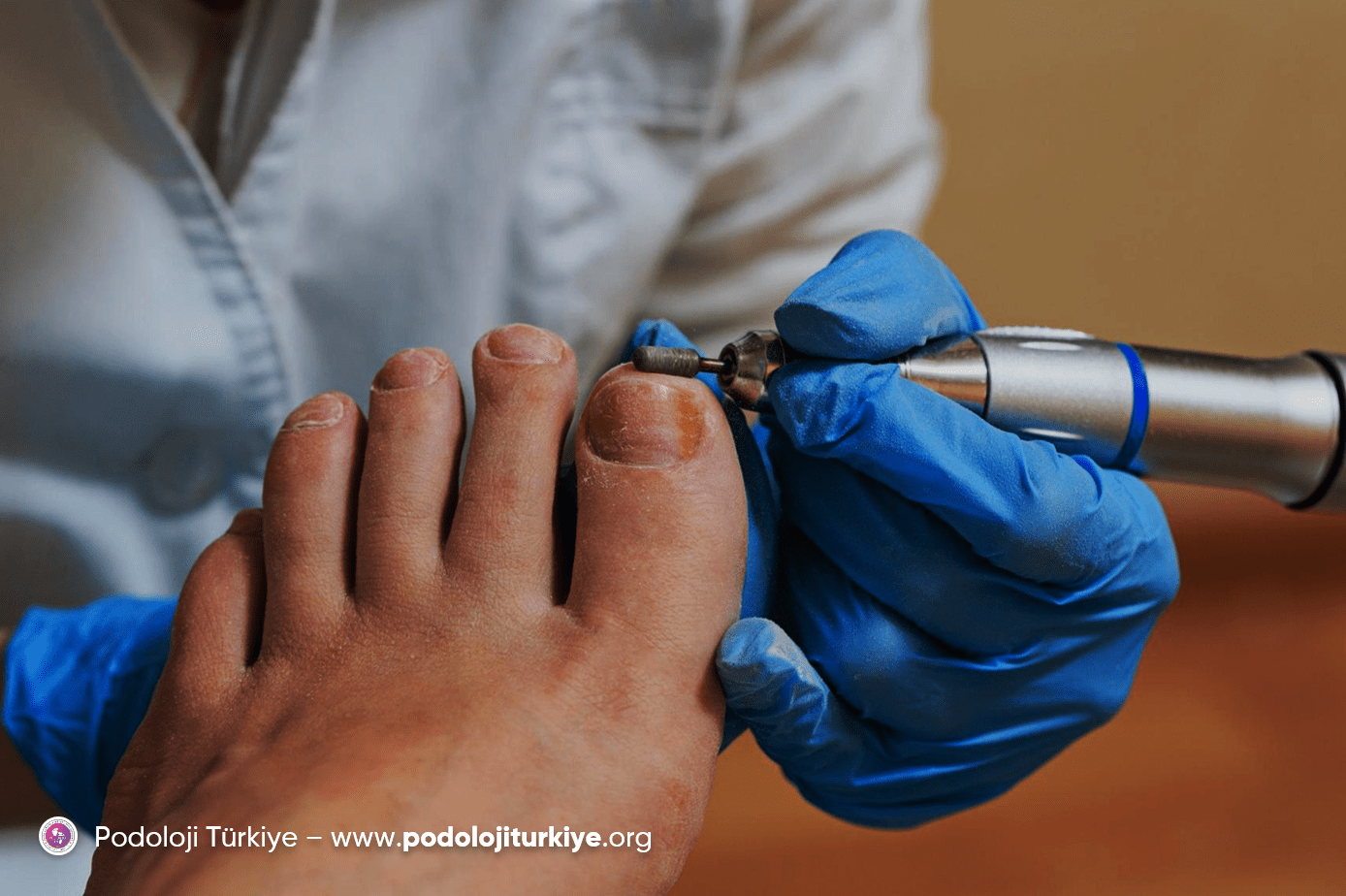 Tırnak Mantarı'nda oral antifungal kullanımı ve podolojik destek 11 Tırnak Mantarı'nda oral antifungal kullanımı ve podolojik destek